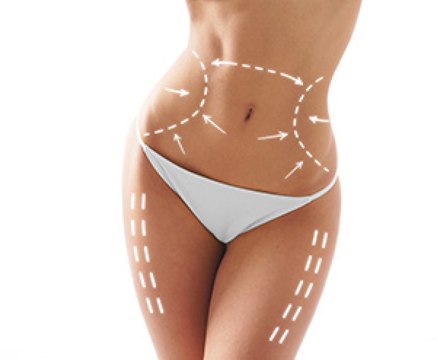 Liposucción en glúteos, piernas y abdomen para eliminar grasa 