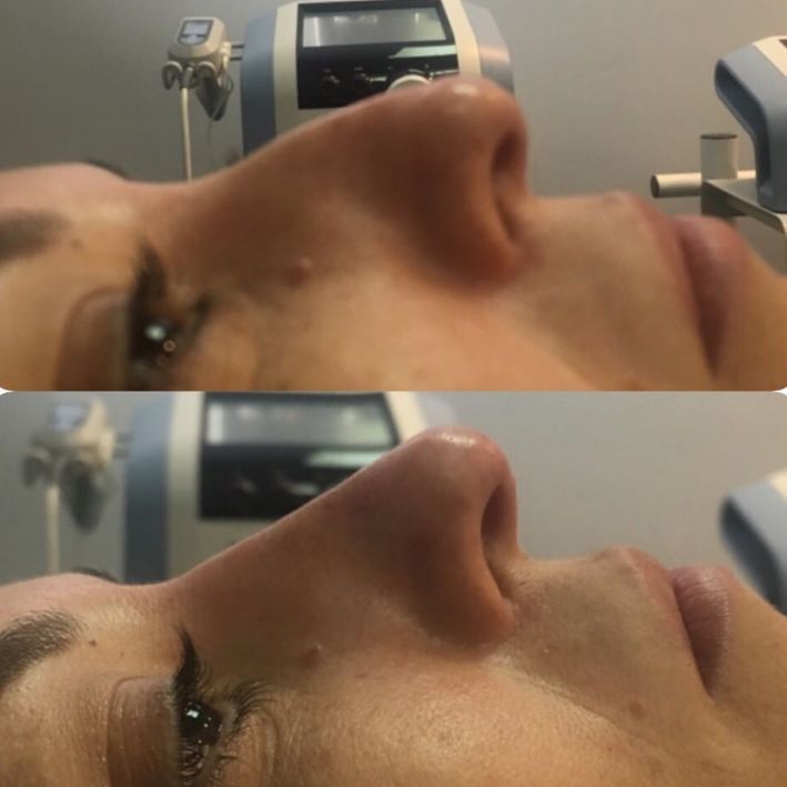 Rinomodelación: Cambia tu nariz sin cirugía