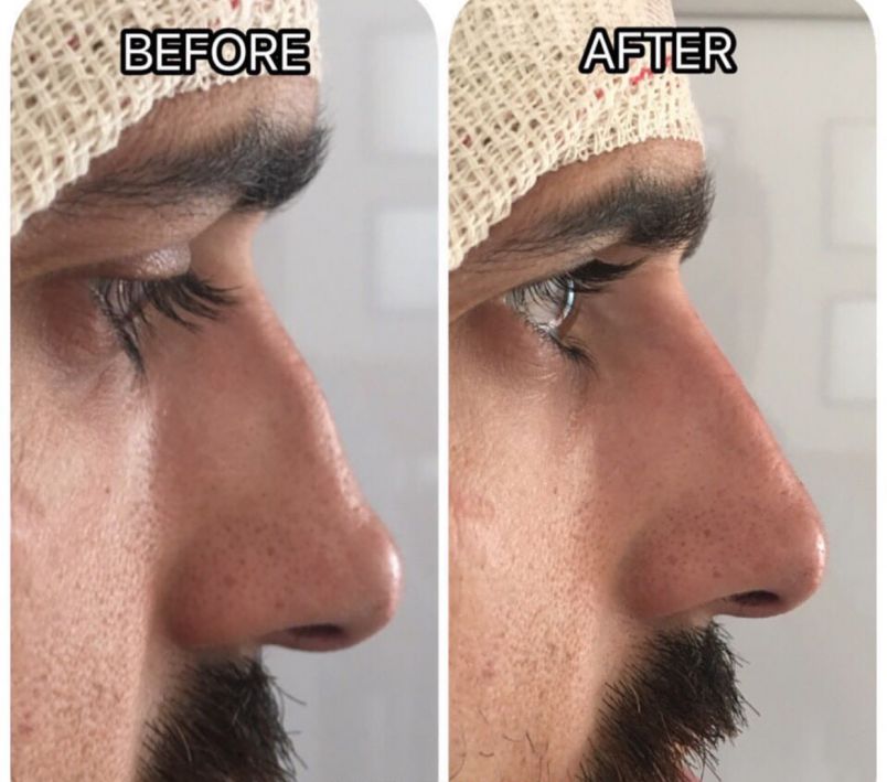 Rinomodelación, cambia tu nariz sin cirugía en Beauty & Co