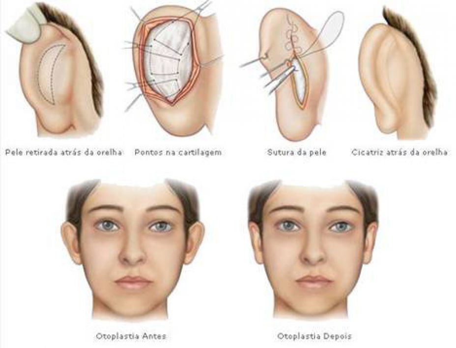 Corrección de orejas de soplillo con Otoplastia